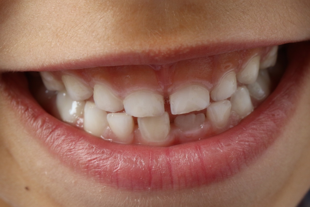 sonhar com dente quebrado